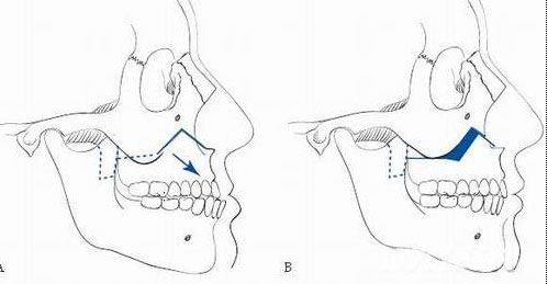 从正颌外科的角度解读鼻基底的概念