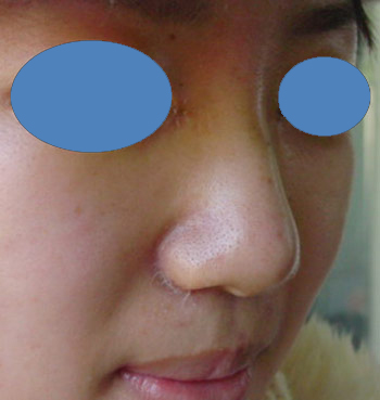 何医生整形手术实例:鼻翼缩小术后一周的疤痕情况